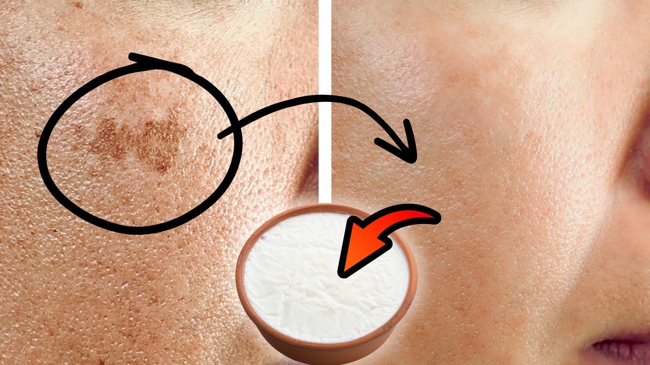 I Erased My Age Spots With a Cheap Kitchen Ingredient — Baking Soda Paste